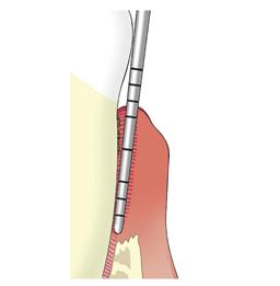 Pocketsonde width=