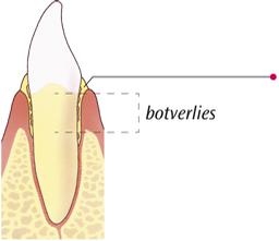 Parodontitis