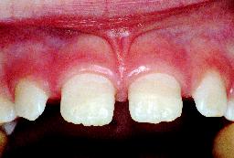 Tanden hersteld uitsnede