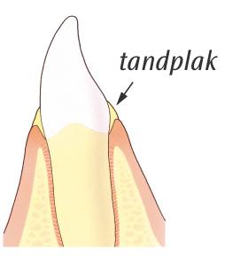 Tandplak