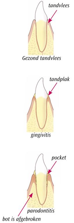 gingivitis parodontitis